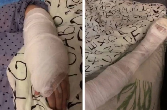 На Урале женщина получила перелом руки в травмпункте, куда приехала со сломанной ногой